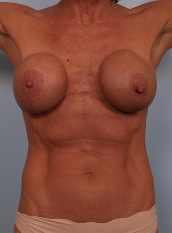 Complex Breast Revision Before & After Gallery - Patient 1310467 - Image 7