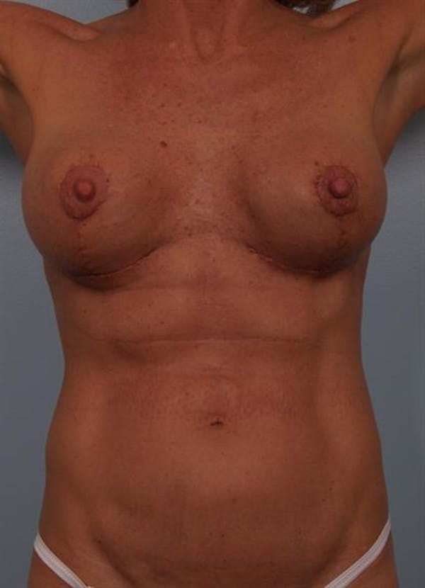Complex Breast Revision Before & After Gallery - Patient 1310467 - Image 8