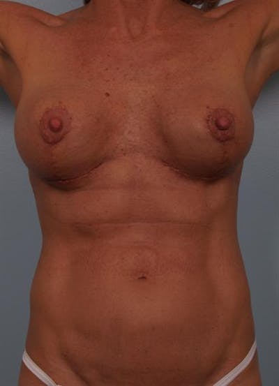 Complex Breast Revision Before & After Gallery - Patient 1310467 - Image 8