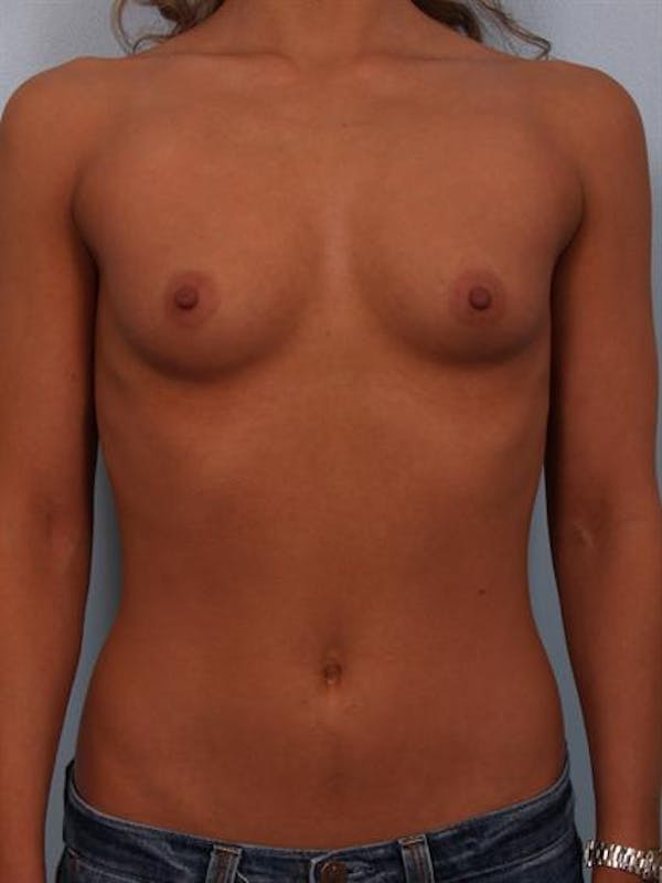Breast Augmentation Gallery - Patient 1310471 - Image 5