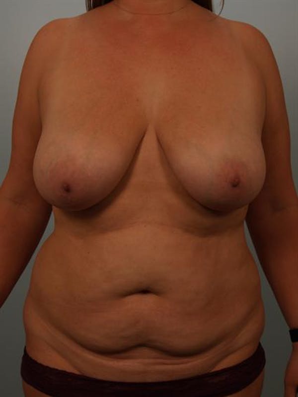 Breast Lift Gallery - Patient 1310473 - Image 1
