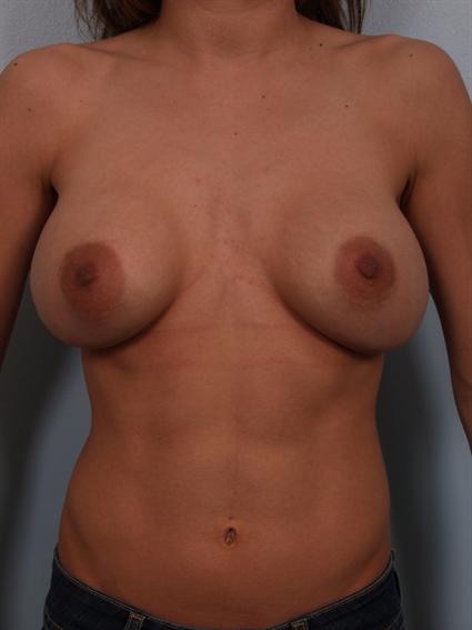 Before image of Breast Revision in Beverly Hills by Dr. Cohen.