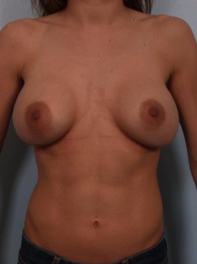 Complex Breast Revision Before & After Gallery - Patient 1310478 - Image 1