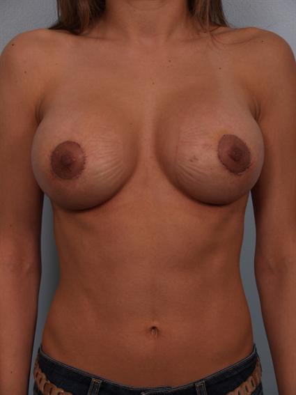 After image of Breast Revision in Beverly Hills by Dr. Cohen.