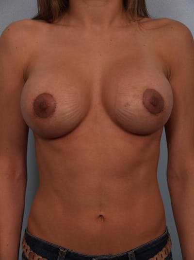 Complex Breast Revision Before & After Gallery - Patient 1310478 - Image 2