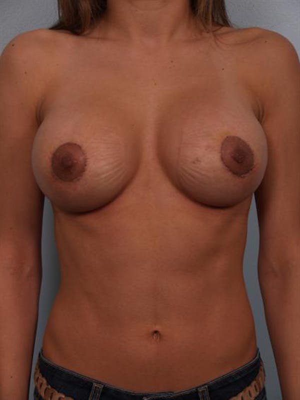 Complex Breast Revision Before & After Gallery - Patient 1310478 - Image 2