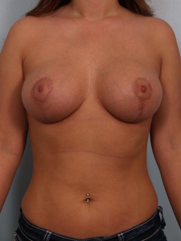 Breast Lift Before & After Gallery - Patient 1310477 - Image 2