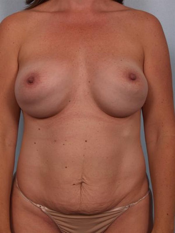 Complex Breast Revision Gallery - Patient 1310482 - Image 1