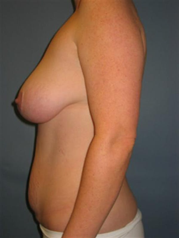 Breast Lift Gallery - Patient 1310486 - Image 3