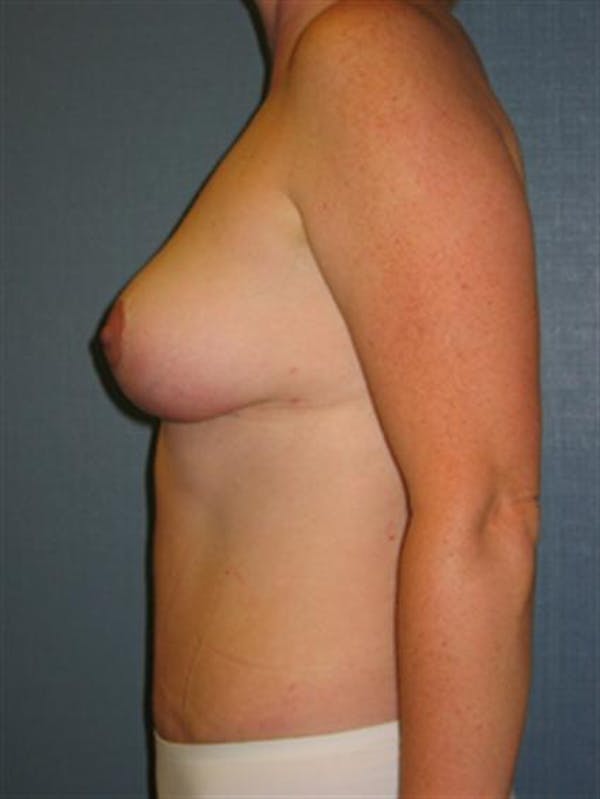 Breast Lift Gallery - Patient 1310486 - Image 4