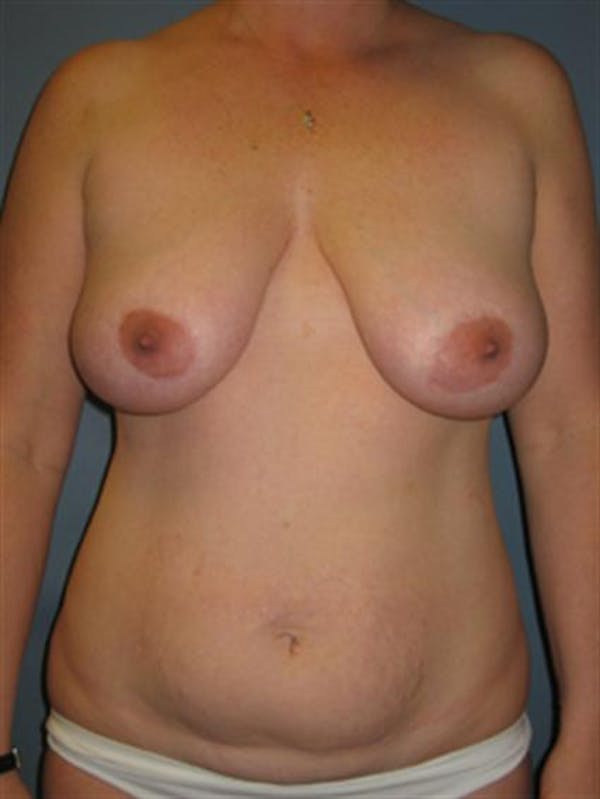 Breast Lift Gallery - Patient 1310486 - Image 1