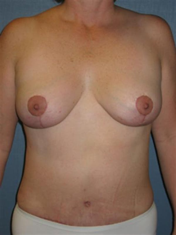 Breast Lift Before & After Gallery - Patient 1310486 - Image 2
