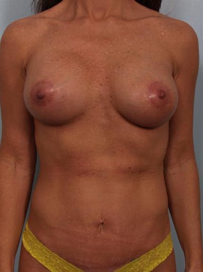Complex Breast Revision Gallery - Patient 1310487 - Image 2