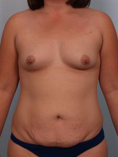 Breast Augmentation Before & After Gallery - Patient 1310490 - Image 1