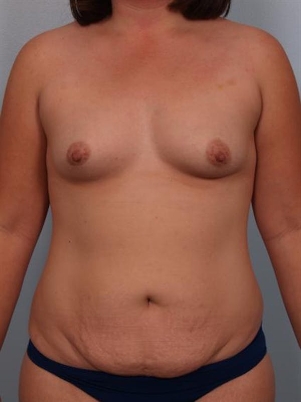 Breast Augmentation Before & After Gallery - Patient 1310490 - Image 1