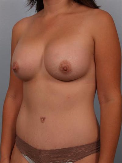 Breast Augmentation Before & After Gallery - Patient 1310490 - Image 4