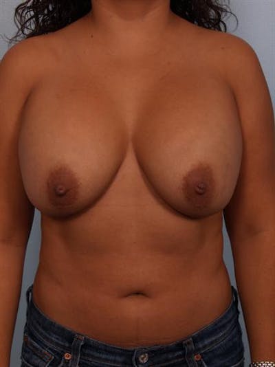 Breast Lift Before & After Gallery - Patient 1310489 - Image 1