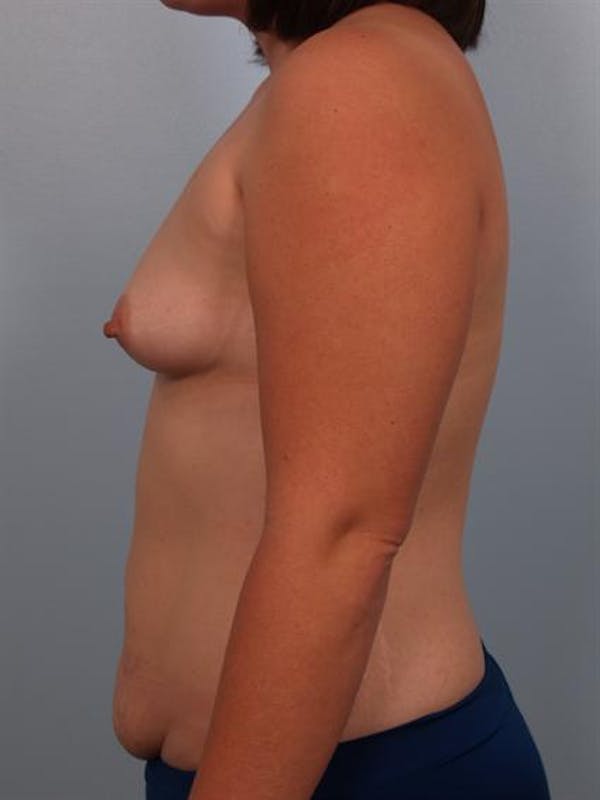 Breast Augmentation Before & After Gallery - Patient 1310490 - Image 5