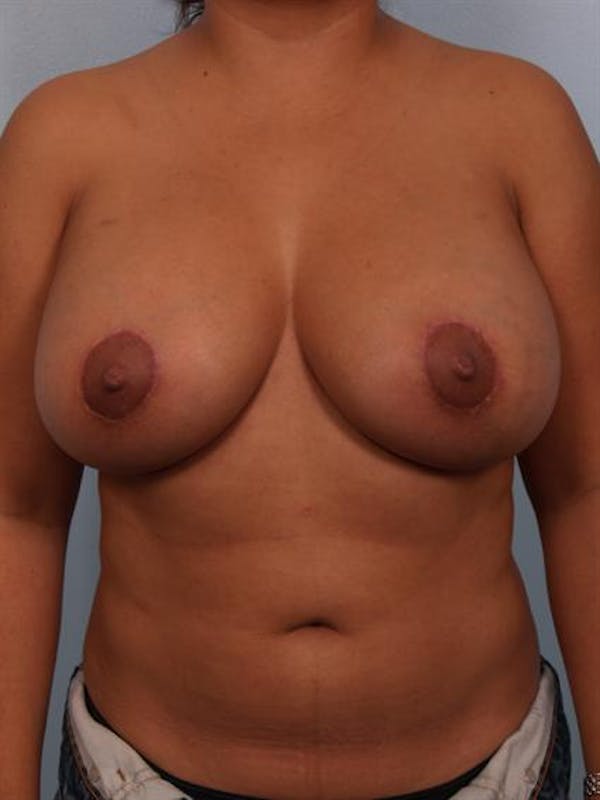 Breast Lift Before & After Gallery - Patient 1310489 - Image 2