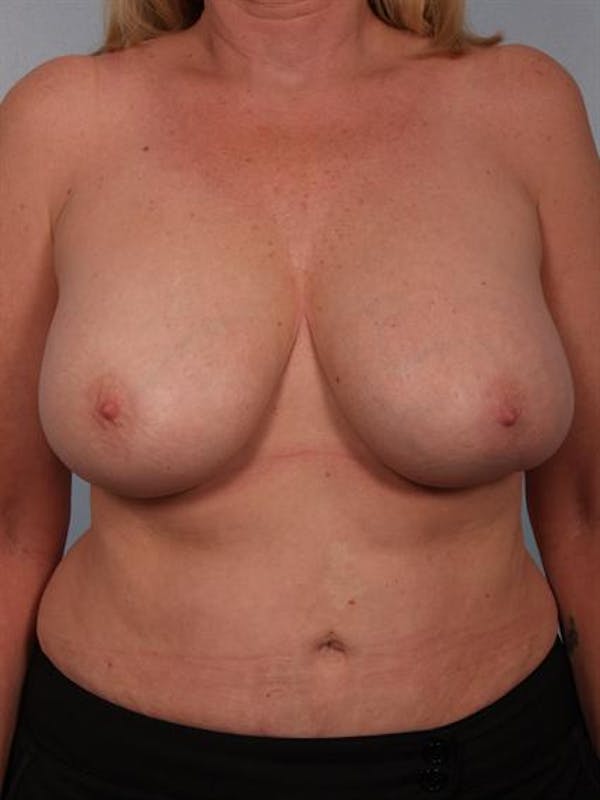 Complex Breast Revision Before & After Gallery - Patient 1310491 - Image 1