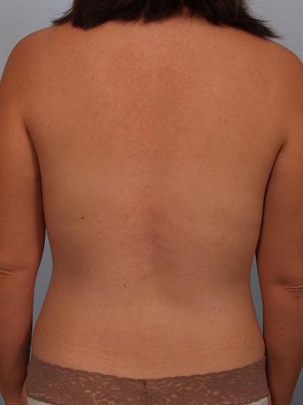Breast Augmentation Before & After Gallery - Patient 1310490 - Image 8