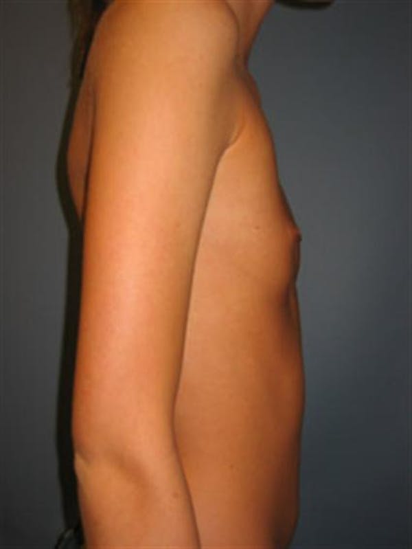 Breast Augmentation Gallery - Patient 1310495 - Image 1
