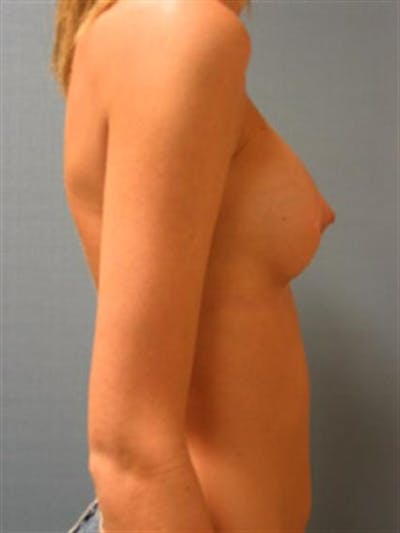 Breast Augmentation Before & After Gallery - Patient 1310495 - Image 2