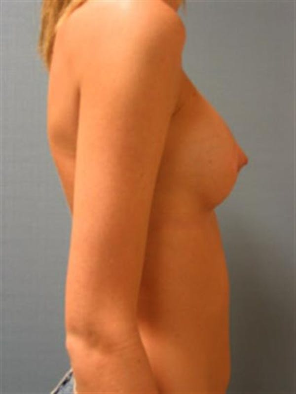 Breast Augmentation Gallery - Patient 1310495 - Image 2