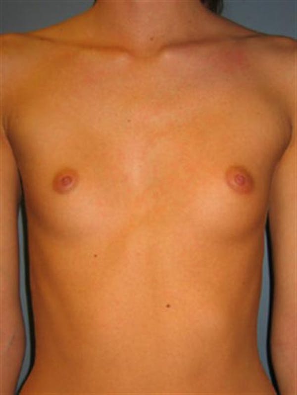 Breast Augmentation Gallery - Patient 1310495 - Image 3