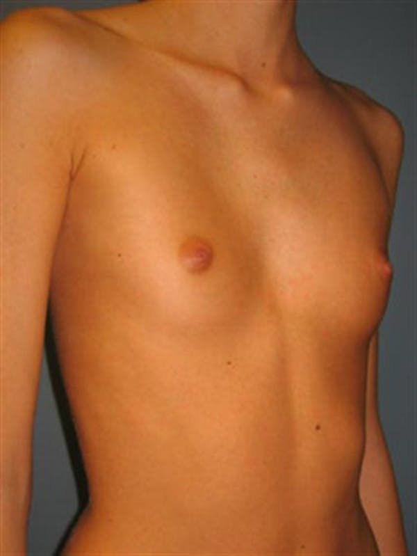 Breast Augmentation Before & After Gallery - Patient 1310495 - Image 5