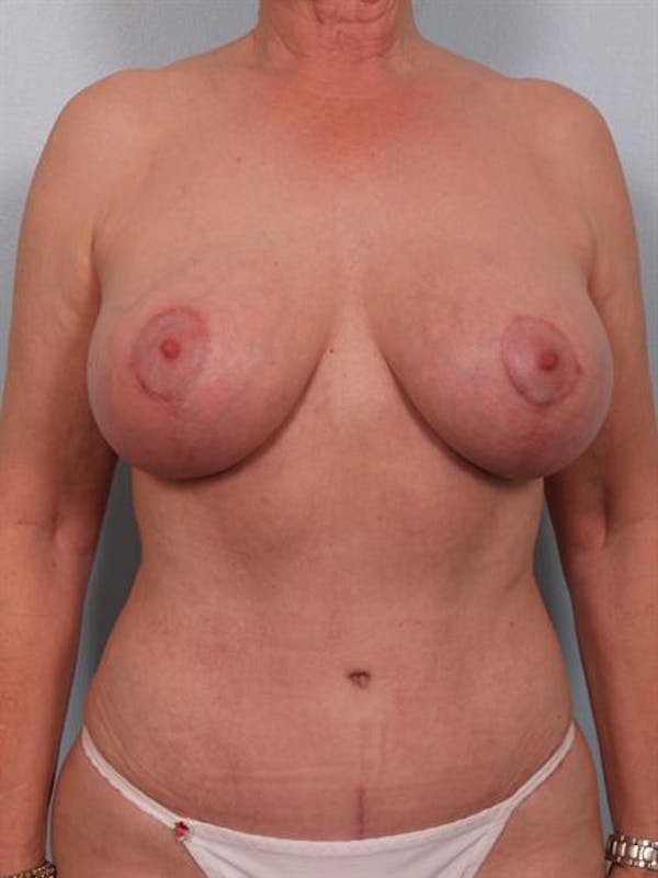 Breast Lift Before & After Gallery - Patient 1310497 - Image 2