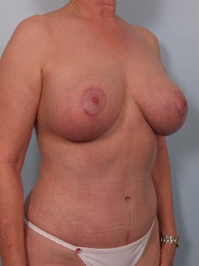 Breast Lift Before & After Gallery - Patient 1310497 - Image 6