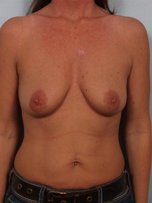 Breast Lift Before & After Gallery - Patient 1310503 - Image 1