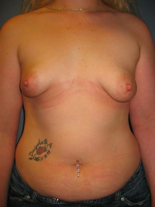 Tuberous Breast Surgery Gallery - Patient 1310505 - Image 1