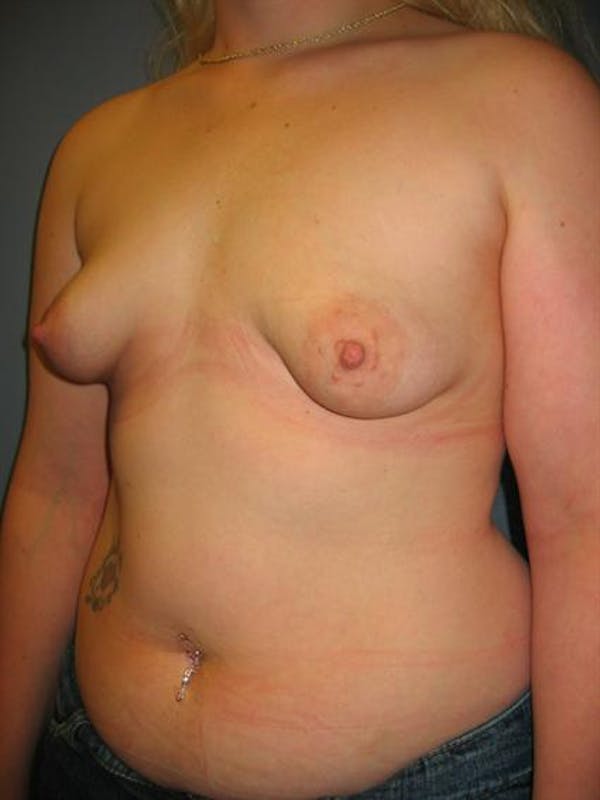 Tuberous Breast Surgery Before & After Gallery - Patient 1310505 - Image 3