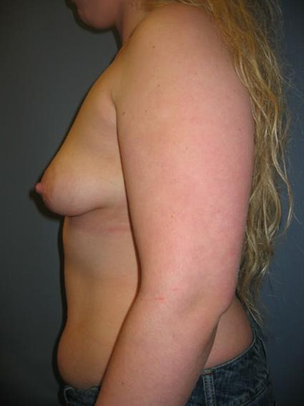 Tuberous Breast Surgery Before & After Gallery - Patient 1310505 - Image 5
