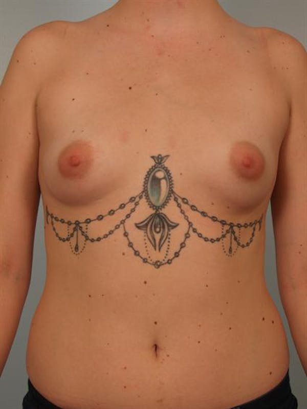 Breast Augmentation Gallery - Patient 1310506 - Image 1