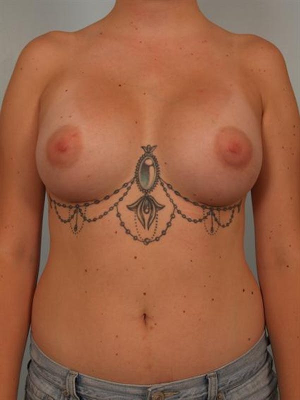 Breast Augmentation Before & After Gallery - Patient 1310506 - Image 2