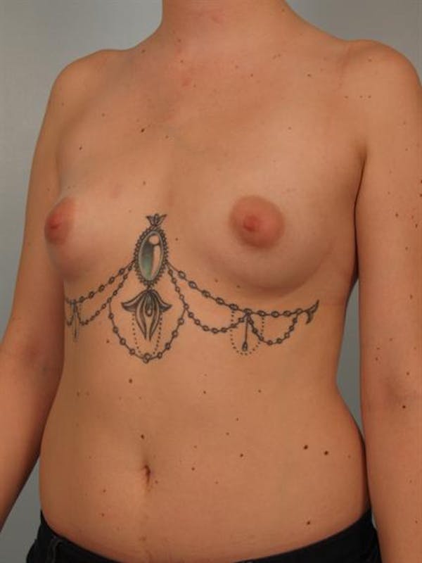 Breast Augmentation Gallery - Patient 1310506 - Image 3