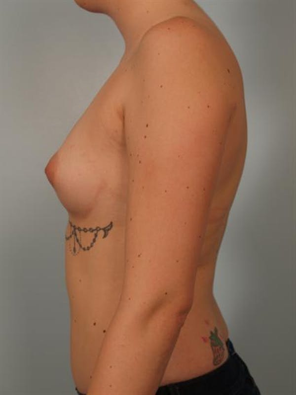 Breast Augmentation Before & After Gallery - Patient 1310506 - Image 5