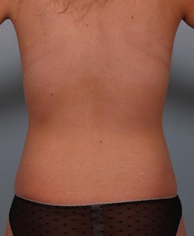 Tuberous Breast Surgery Before & After Gallery - Patient 1310505 - Image 10