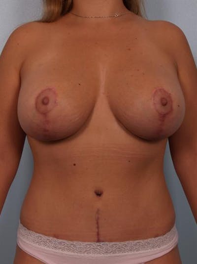 Breast Lift Before & After Gallery - Patient 1310508 - Image 2