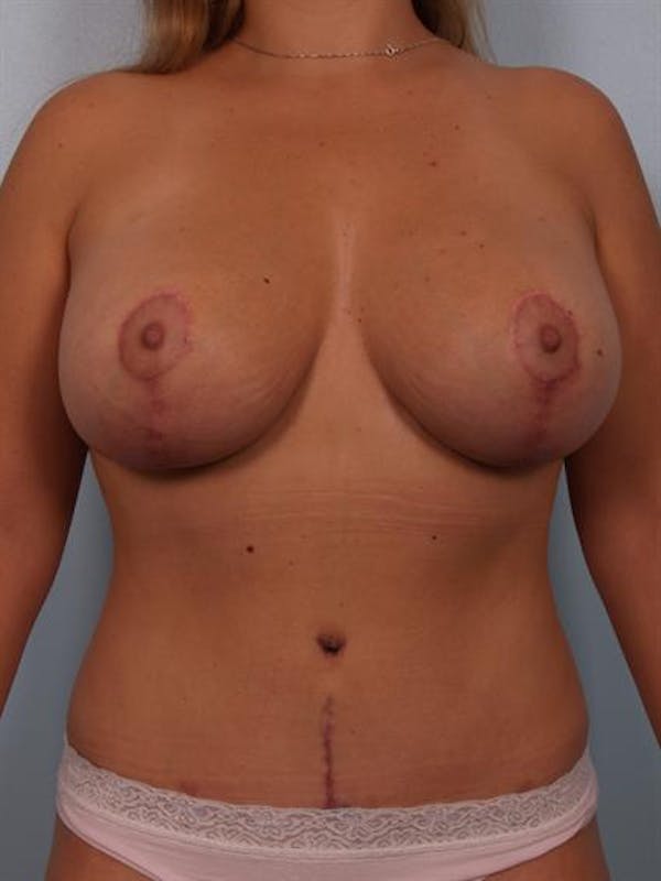 Breast Lift Before & After Gallery - Patient 1310508 - Image 2