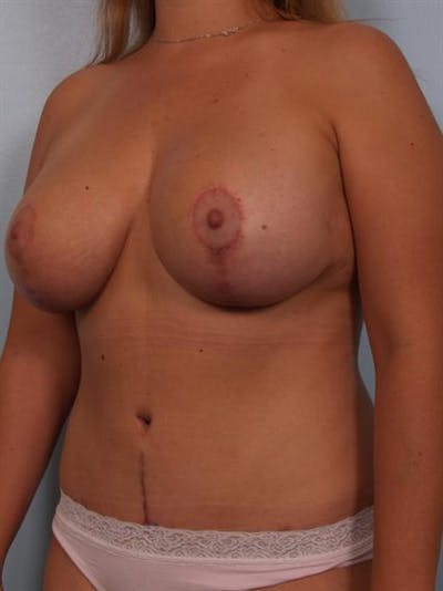 Breast Lift Before & After Gallery - Patient 1310508 - Image 6
