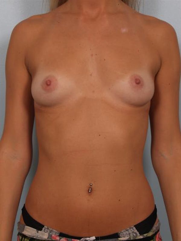 Breast Augmentation Before & After Gallery - Patient 1310512 - Image 1