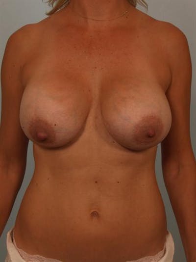 Complex Breast Revision Before & After Gallery - Patient 1310510 - Image 1
