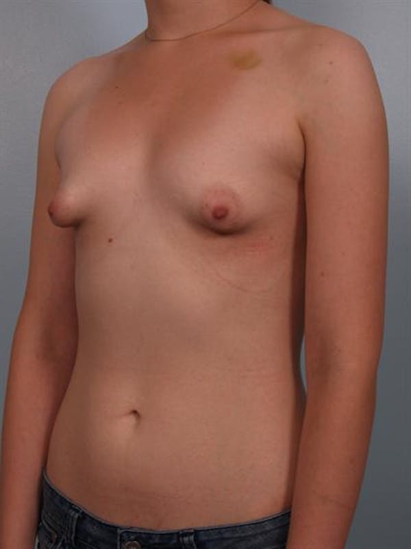 Tuberous Breast Surgery Before & After Gallery - Patient 1310509 - Image 5