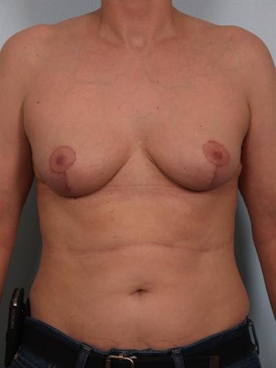 Breast Lift Before & After Gallery - Patient 1310511 - Image 2