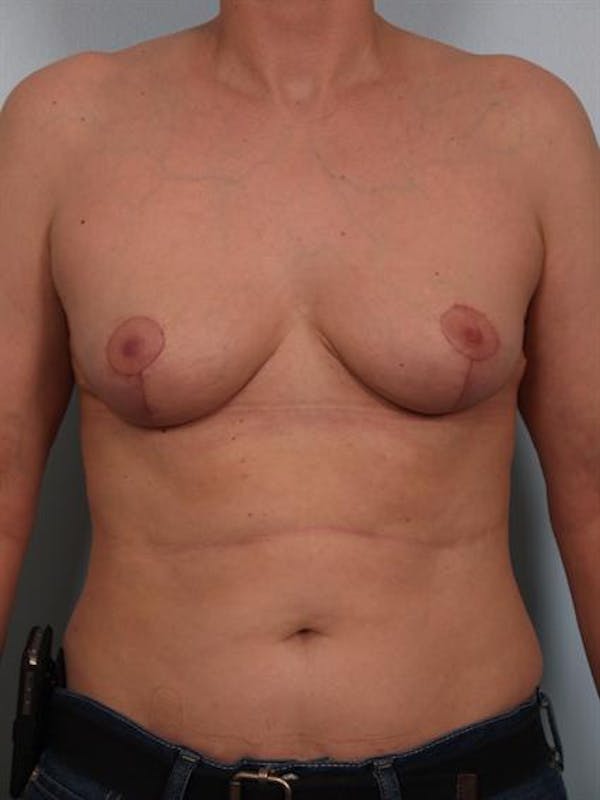 Breast Lift Gallery - Patient 1310511 - Image 2