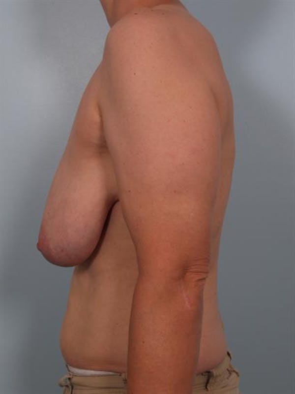 Breast Lift Gallery - Patient 1310511 - Image 3